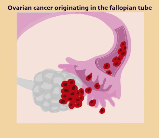Best Ovarian Cancer Specialist In Ahmedabad | Dr. Aditi Bhatt